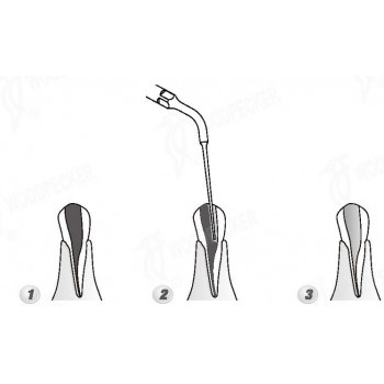 Woodpecker® ED4 DTE根管治療用チップ（SATELECと交換、5本入）