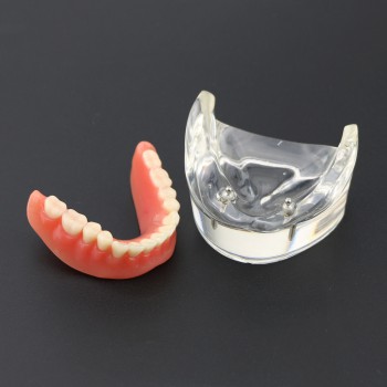 歯科モデル下顎重塁義歯教学用模型 2本インプラント6002 01
