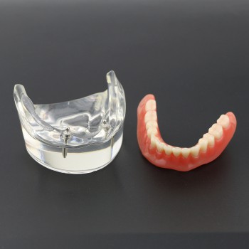歯科モデル下顎重塁義歯教学用模型 2本インプラント6002 01