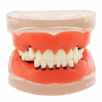 歯科開閉式歯結石模型 上下顎歯周萎縮模型 歯科研究治療説明用歯列疾患モデル  クリアベース