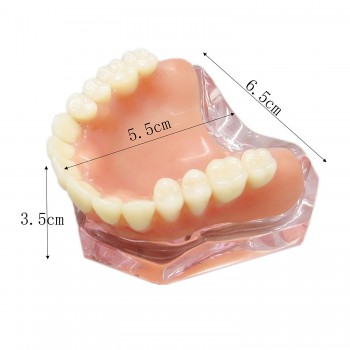 歯科インプラント研究治療説明用歯列模型 上顎モデル 4本釘 取り外し可能