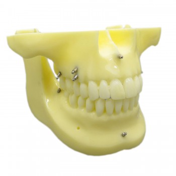 歯科矯正用上下顎歯列模型モデル インプラント スクリューアンカー付き 脱着可能 イエローベース