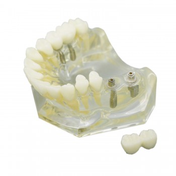 歯科透明インプラント治療説明用モデル 上顎模型 4本インプラント 脱着可能 クリアベース
