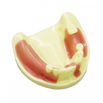 歯科下顎インプラント研究練習用道具 義歯模型 標準教学道具 イエローベース