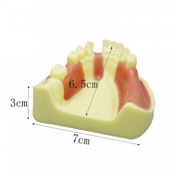 歯科下顎インプラント研究練習用道具 義歯模型 標準教学道具 イエローベース