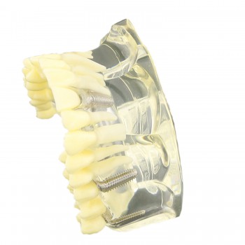 歯科上顎透明インプラントモデル模型 歯列研究用治療説明用教学模型 脱着可能 4本インプラント クリアベース