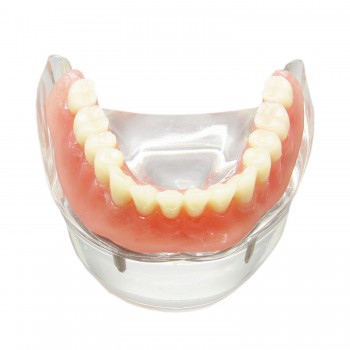 歯科下顎研究治療説明用歯科模型 インプラント用義歯モデル模型 4本インプラント脱着可能 クリアベース 透明