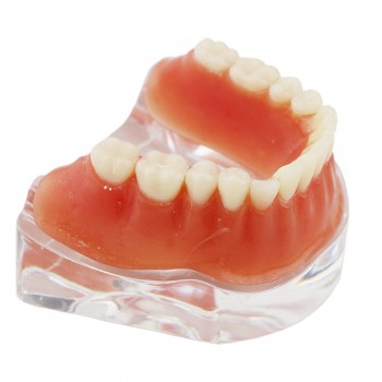 歯科下顎インプラントモデル模型 バーアタッチメント義歯模型 研究用治療説明歯列模型 クリアベース 4本インプラント