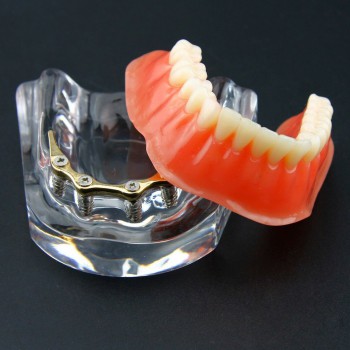 歯科下歯モデル 義歯模型 オーバーデンチャー 模型 精密インプラント ゴールデン下顎模型 教学用 歯模型 学習用 6009
