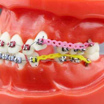 歯列矯正モデル 模型 歯科 矯正治療説明用 研究用モデル 金属ブラケット アーチワイヤーチェーン付き