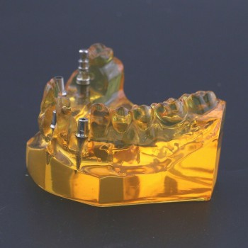 歯科上顎インプラント模型 歯科用デモモデル ＃201102