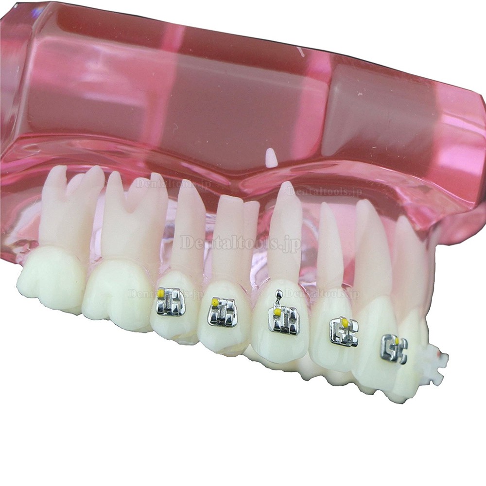 歯科上下顎矯正模型 治療説明用ブラケットモデル セラミック メタル ピンク