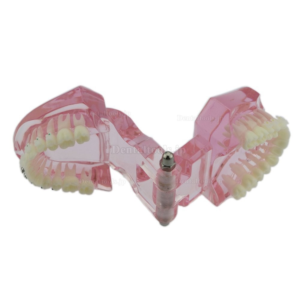 歯科上下顎矯正模型 治療説明用ブラケットモデル セラミック メタル ピンク
