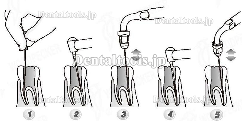 Woodpecker®DTE根管治療用チップED2（SATELECと交換、5本入）