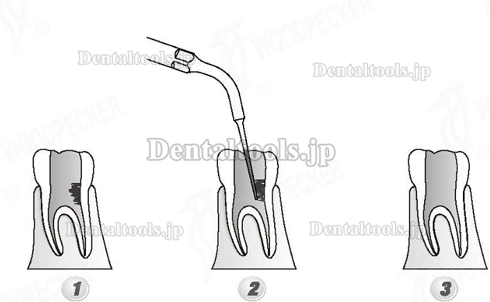 Woodpecker®DTE根管治療用チップED5D（SATELECと交換、5本入）