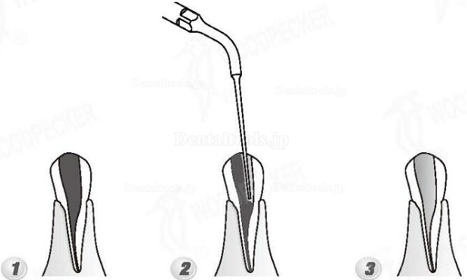 Woodpecker® DTE根管治療用チップED4（SATELECと交換、5本入）