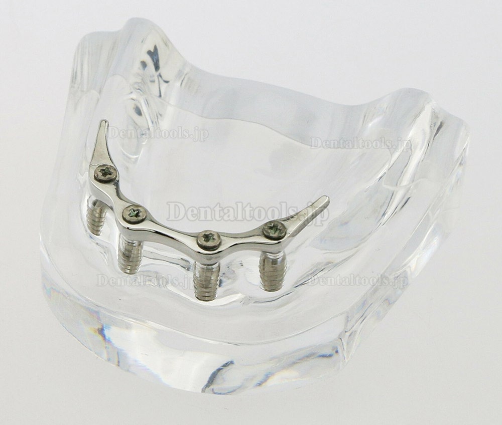歯科下歯モデル 義歯模型 4本インプラント オーバー デンチャー 下顎模型 教学用 歯模型 学習用模型