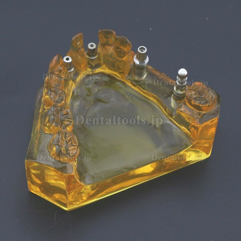 歯科上顎インプラント模型 歯科用デモモデル ＃201102