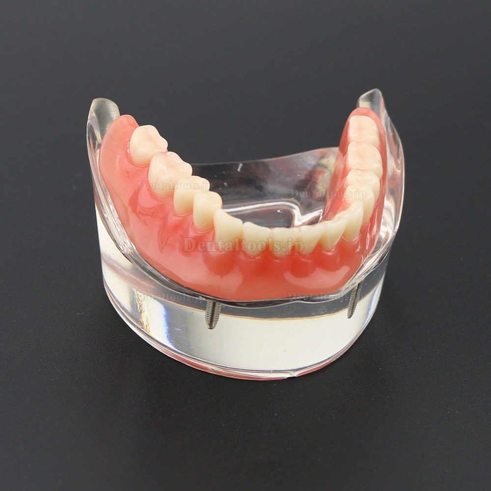 歯科モデル下顎重塁義歯教学用模型　2本インプラント6002 01