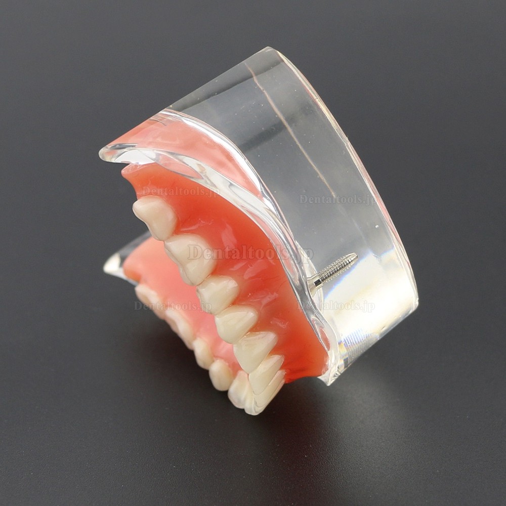 歯科モデル下顎重塁義歯教学用模型　2本インプラント6002 01