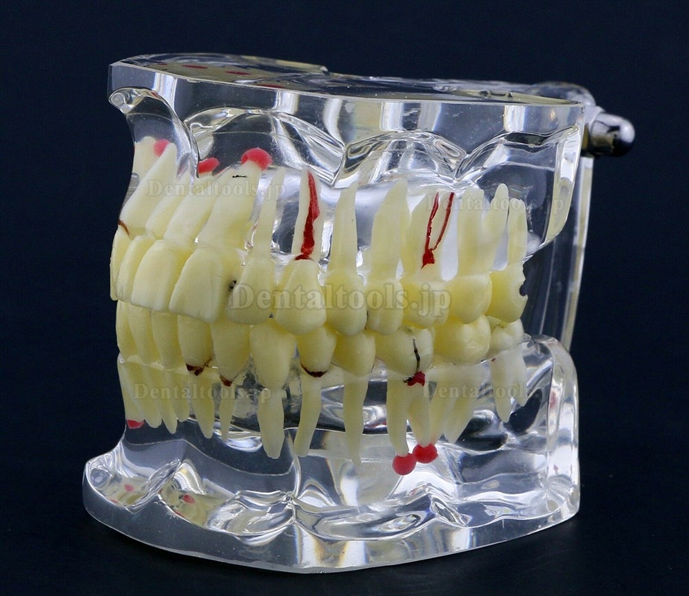 新しい歯科模型 成人病理歯模型 歯列モデル 模型 教学 研究 説明用 #4001