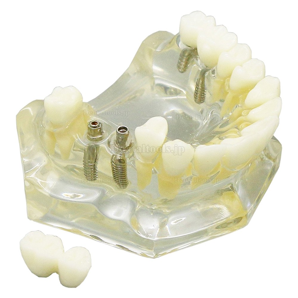 歯科透明インプラント治療説明用モデル 上顎模型 4本インプラント 脱着可能 クリアベース