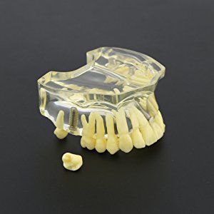 歯科上顎透明インプラントモデル模型 歯列研究用治療説明用教学模型 脱着可能 4本インプラント クリアベース