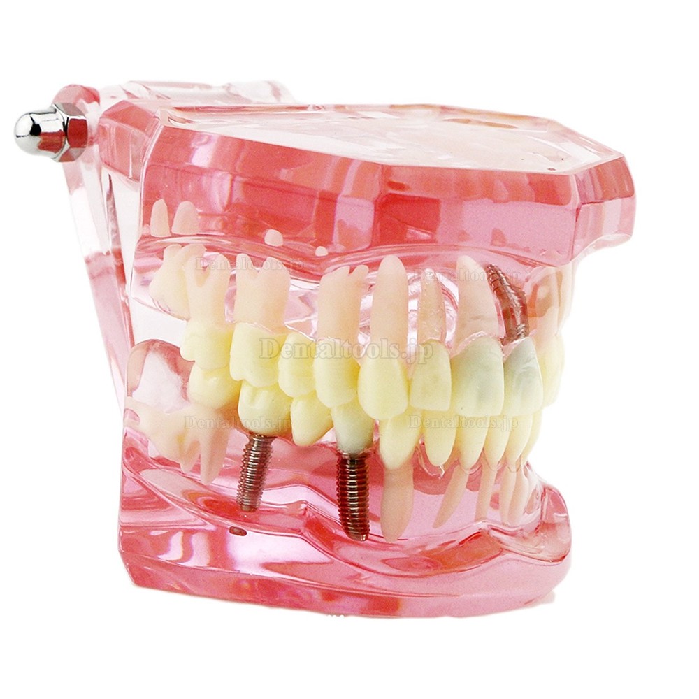 歯の構造虫歯研究治療用模型 歯科上下顎180度開閉式インプラント歯列モデル模型 ピンク