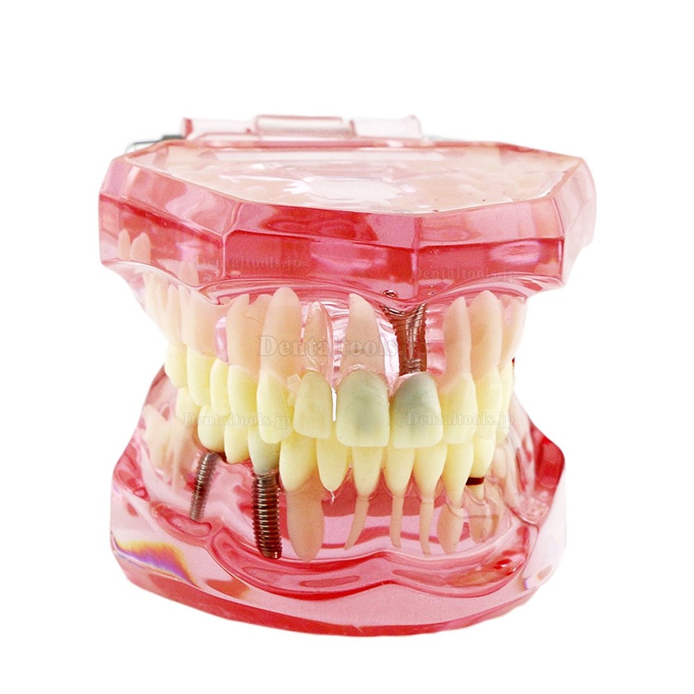 歯の構造虫歯研究治療用模型 歯科上下顎180度開閉式インプラント歯列モデル模型 ピンク