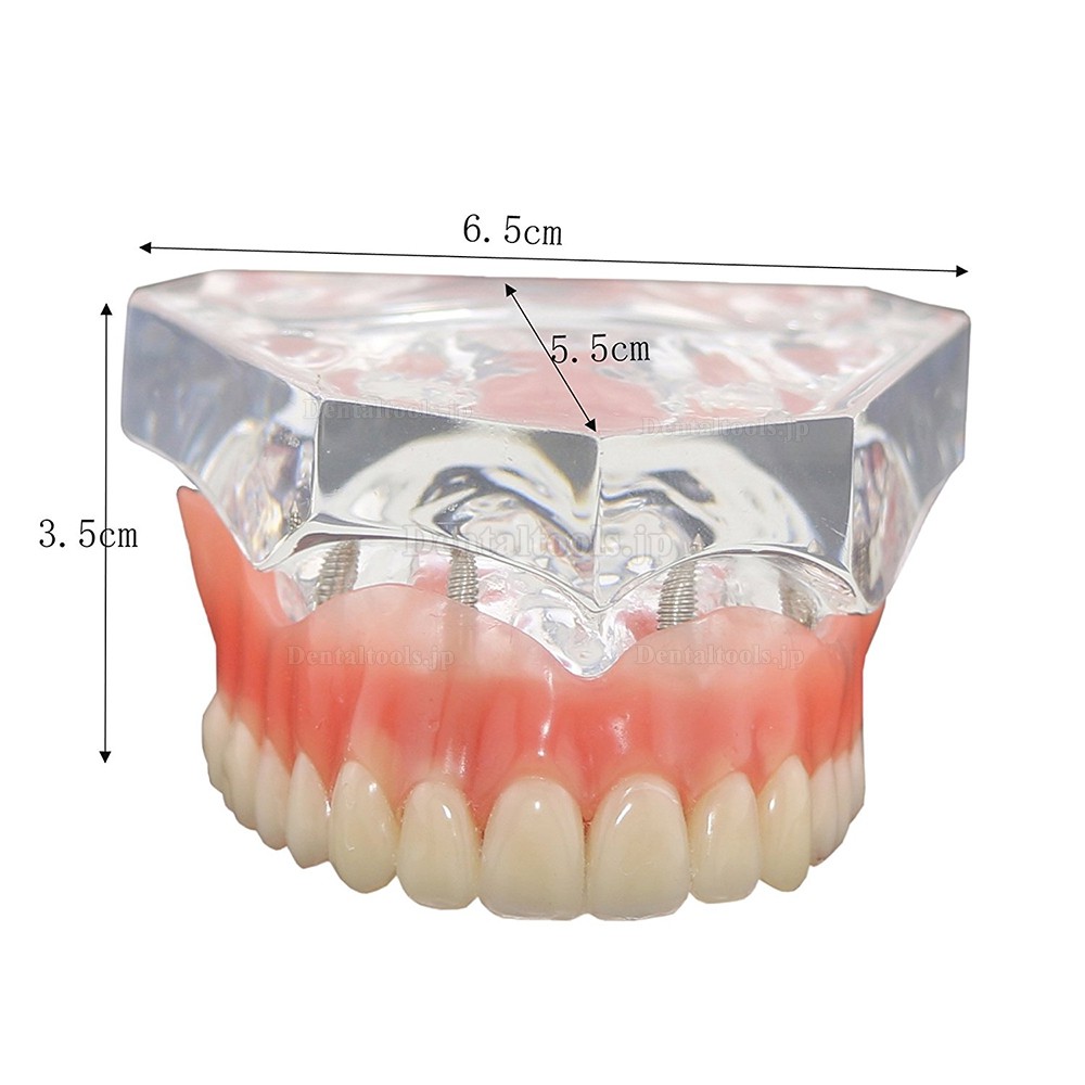 歯科インプラント研究治療説明用歯列模型 上顎モデル 4本釘 取り外し可能