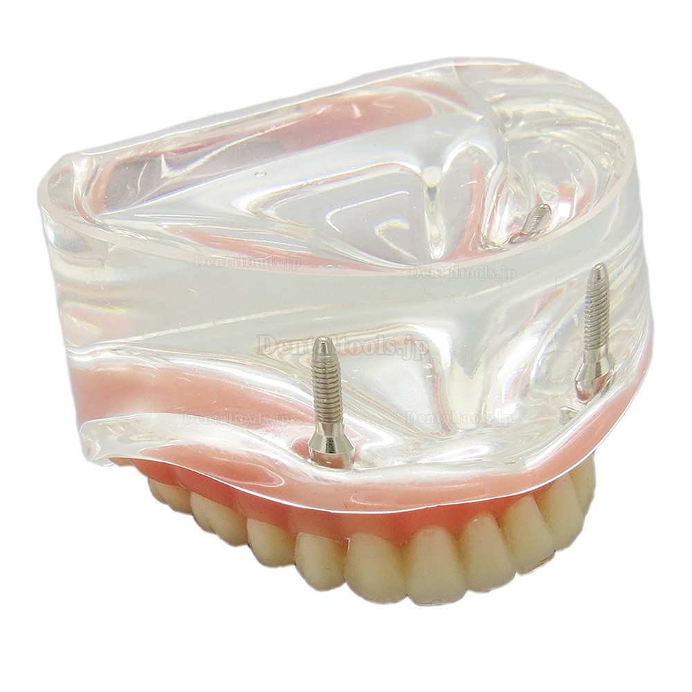 高品質透明歯科インプラント研究治療説明用下顎歯列模型 2本釘 取り外し可能 クリアベース