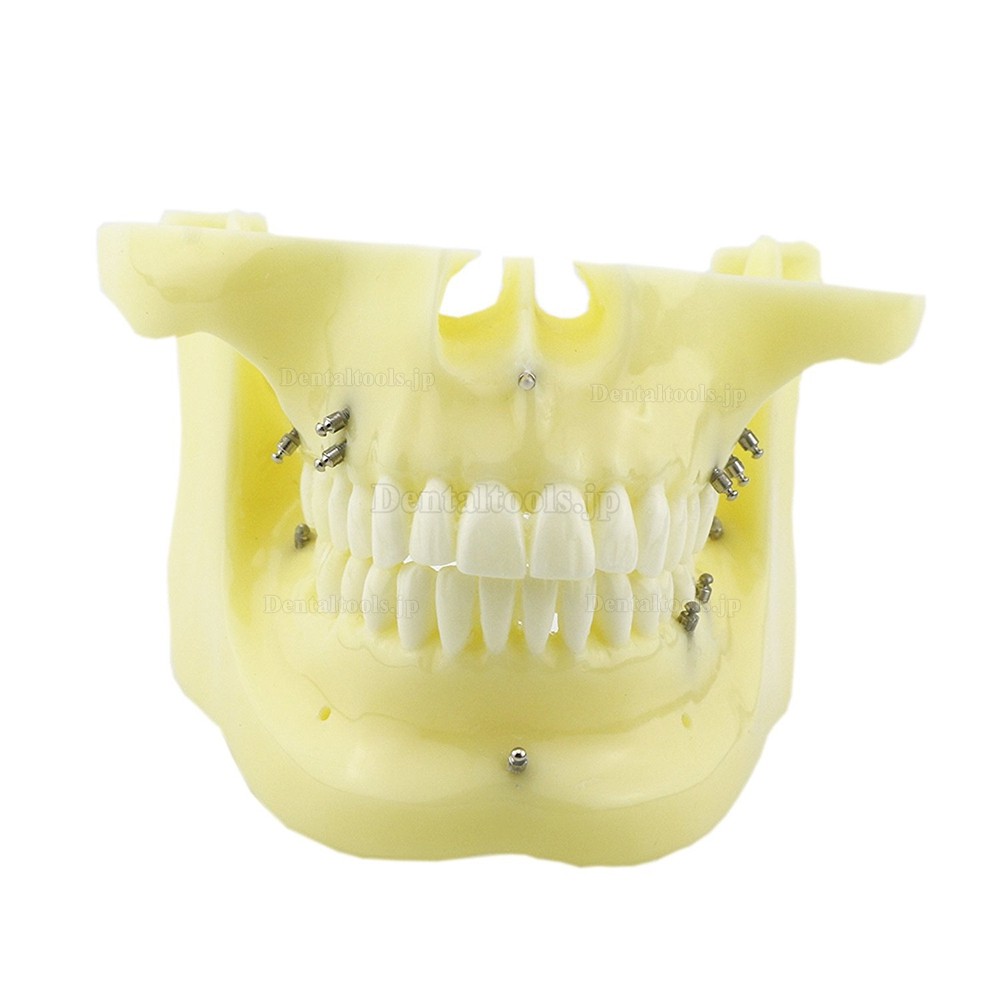 歯科矯正用上下顎歯列模型モデル インプラント スクリューアンカー付き 脱着可能 イエローベース